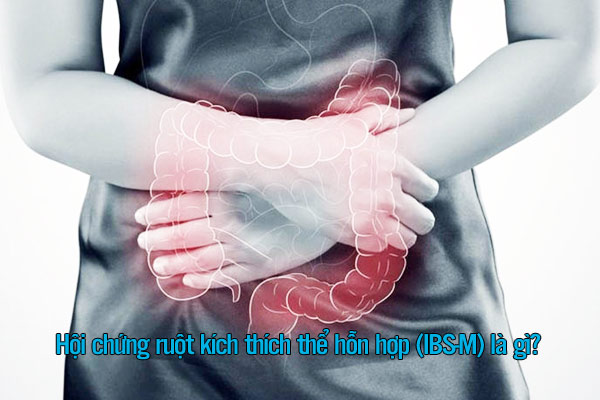 Hội chứng ruột kích thích thể hỗn hợp (IBS-M) là gì?