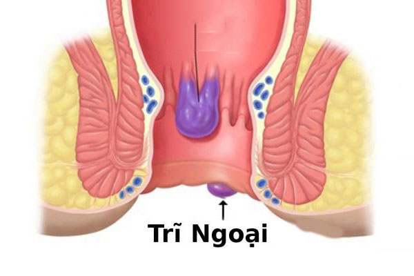 cách chữa bệnh trĩ ngoại tại nhà 