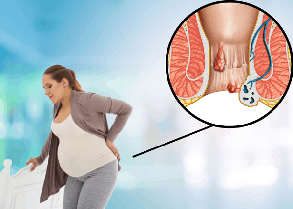 Bà bầu bị trĩ có tự khỏi được không