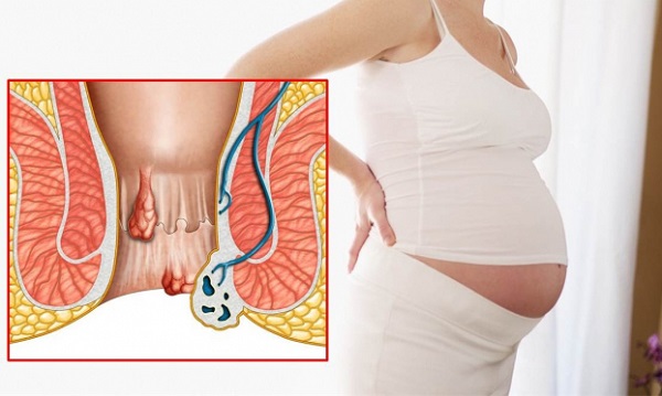 Có nhiều nguyên nhân gây ra bệnh trĩ trong quá trình mang thai